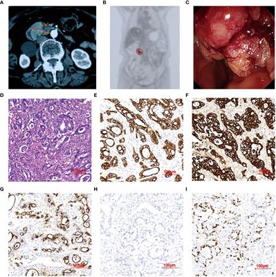 Iodine-125 brachytherapy in inoperable duodenal papilla carcinoma: a case report series